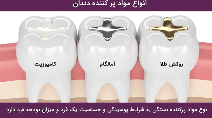 انواع مواد پر کردن
