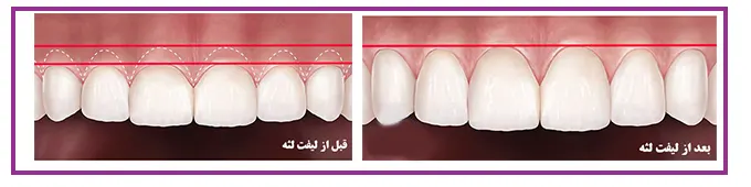 لیفت لثه دندان در جردن