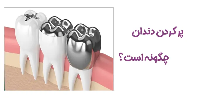 پر کردن دندان