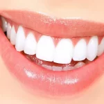 اصلاح طرح لبخند