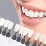 بهترین دندانپزشک برای لمینت دندان