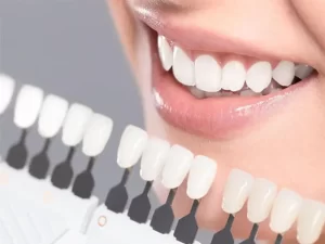 بهترین دندانپزشک برای لمینت دندان