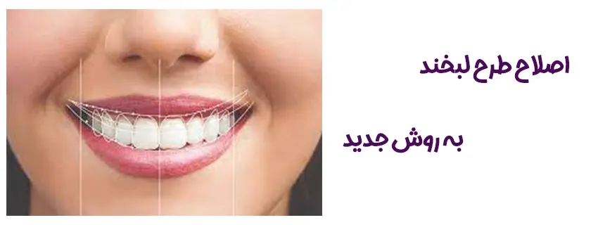 روش جدید طرح لبخند