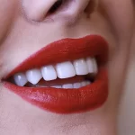 لمینت سرامیکی دندان
