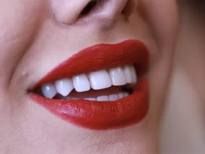 لمینت سرامیکی دندان