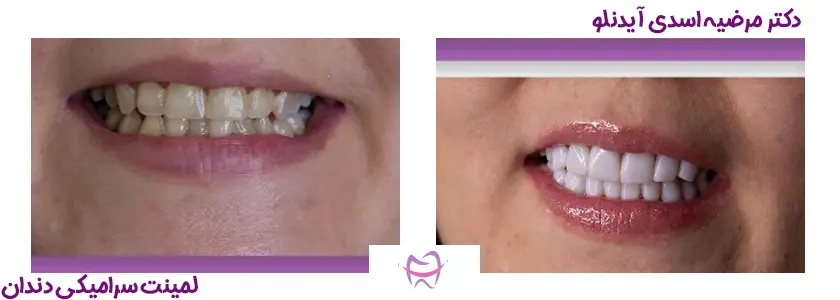 لمینت سرامیکی دندان در جردن