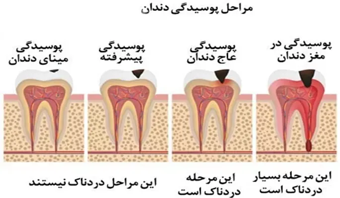 مراحل پوسیدگی دندان