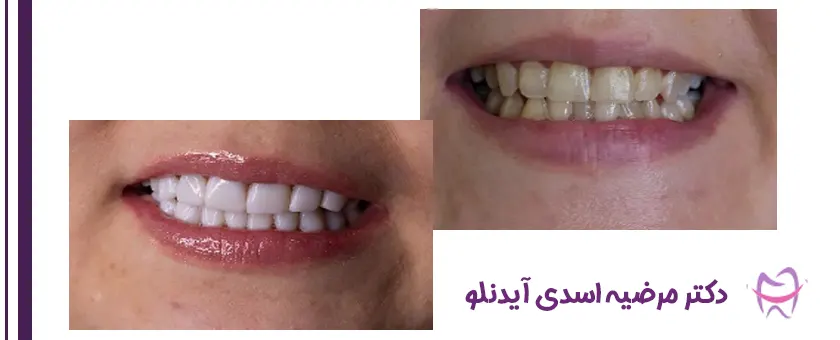 نمونه کار لمینت دندان
