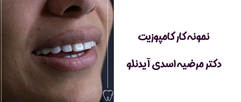 نمونه کامپوزیت ونیر