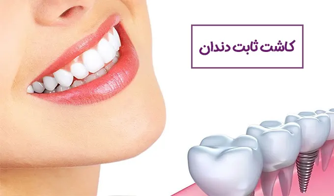 کاشت ثابت دندان