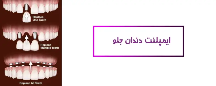 ایمپلنت دندان جلو