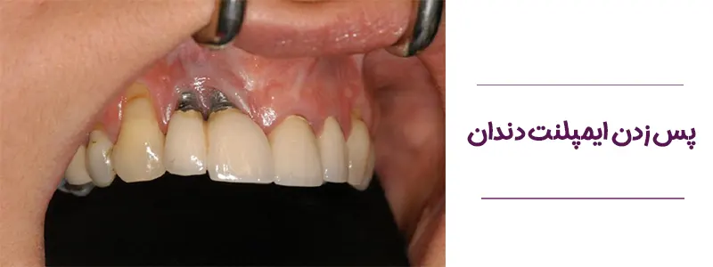 ایمپلنت پس زده شده