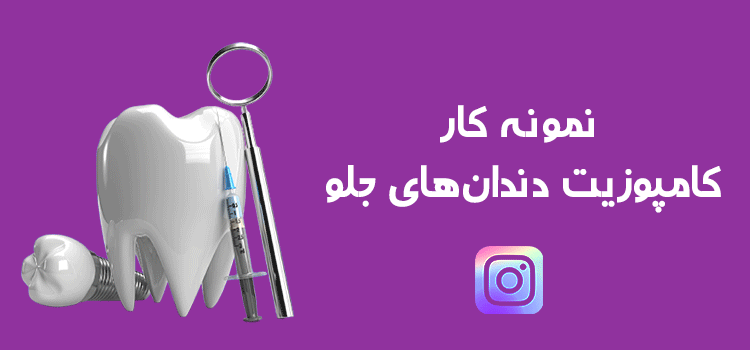 نمونه کامپوزیت دندان جلو در اینستاگرام