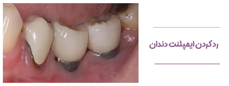 رد کردن ایمپلنت دندان