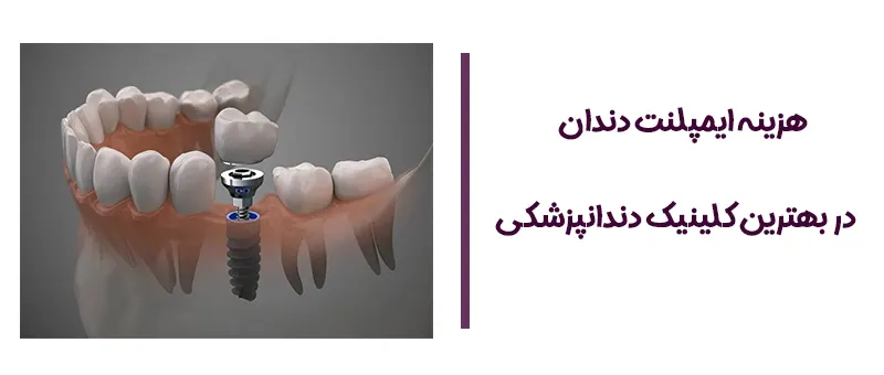 هزینه ایمپلنت دندان