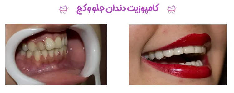 کامپوزیت دندان جلو و کج