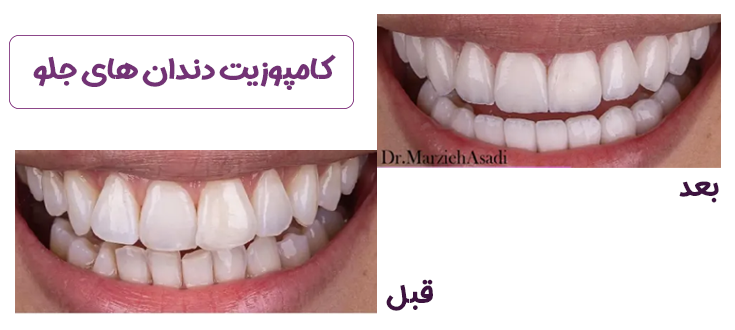 کامپوزیت دندان های جلویی