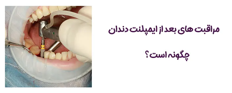 مراقبت های بعد ایمپلنت دندان