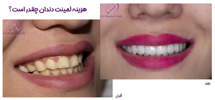 هزینه لمینت دندان در تهران
