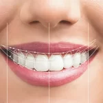 هزینه لمینت دندان چقدر است مرکز طراحی لبخند