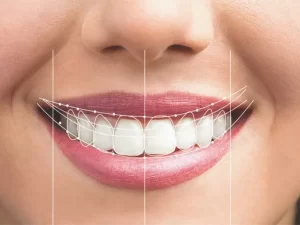 هزینه لمینت دندان چقدر است مرکز طراحی لبخند