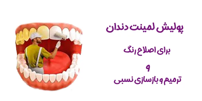 پولیش لمینت دندان