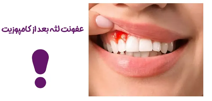 عفونت لثه بعد از کامپوزیت دندان
