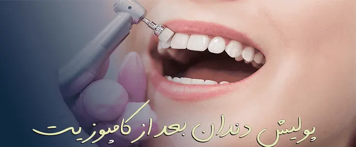 پولیش کامپوزیت دندان