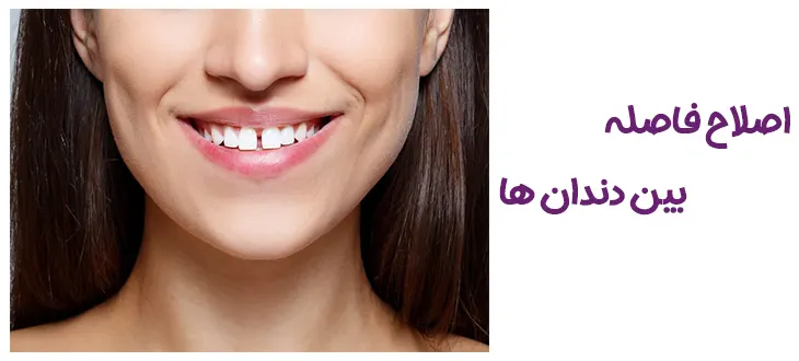 اصلاح فاصله بین دندان ها