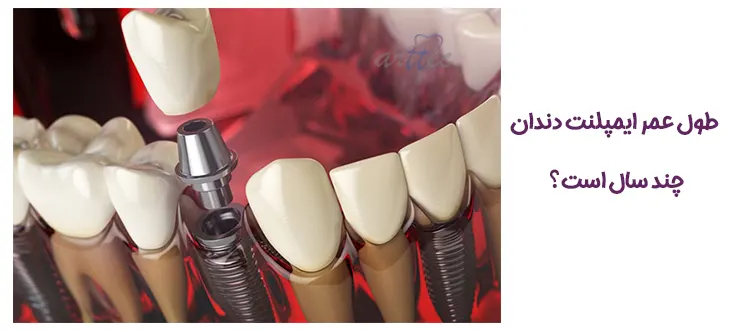 طول عمر ایمپلنت دندان