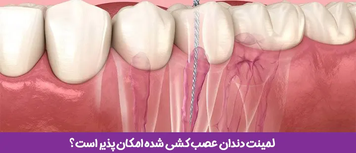 لمینت دندان عصب کشی و سیاه شده