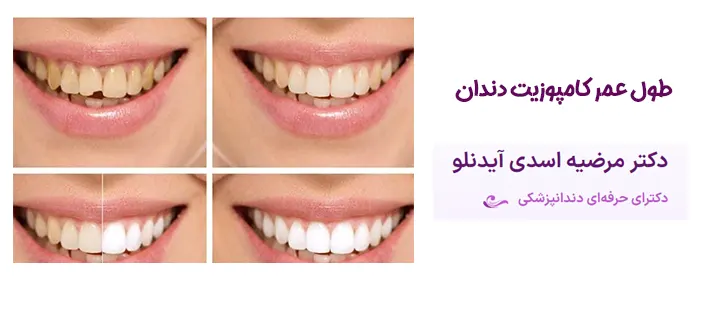 ماندگاری کامپوزیت دندان