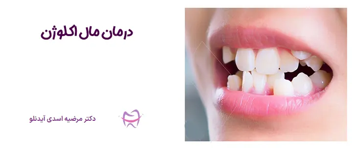 درمان مال اکلوژن