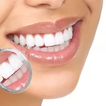 لمینت بدون تراش دندان