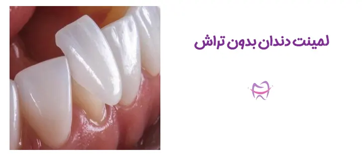 لمینت بدون تراش دندان