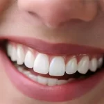 لمینت دندان های خرگوشی