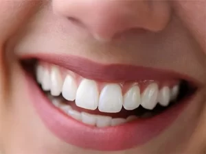 لمینت دندان های خرگوشی