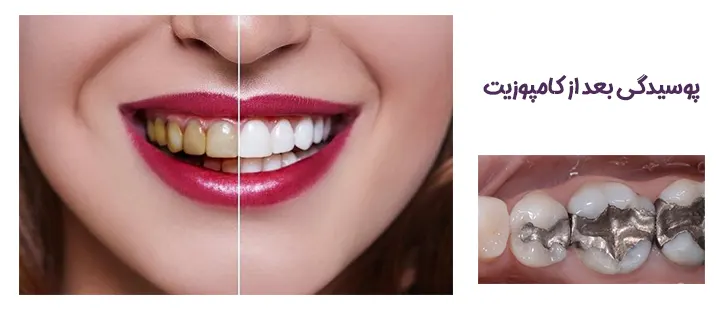 پوسیدگی بعد کامپوزیت دندان