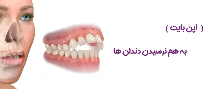 به هم نرسیدن دندان ها
