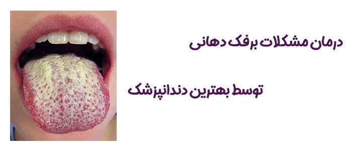بیماری برفک دهان