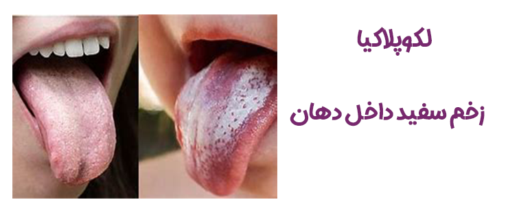 زخم سفید دهان