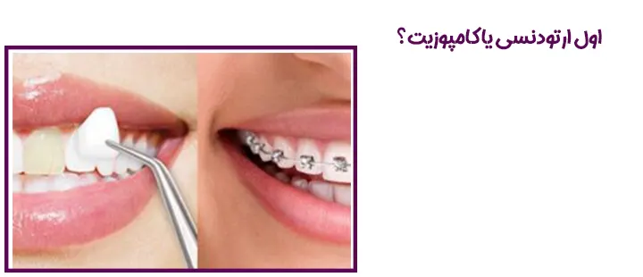اول ارتودنسی یا کامپوزیت؟