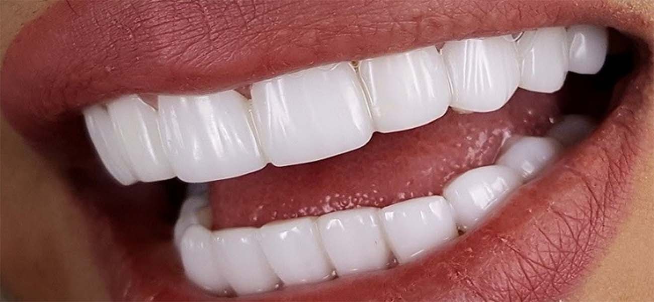 بهترین مرکز لمینت سرامیکی دندان