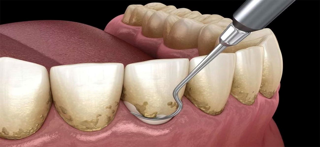 جرم گیری دندان هر چند وقت یکبار لازم است؟
